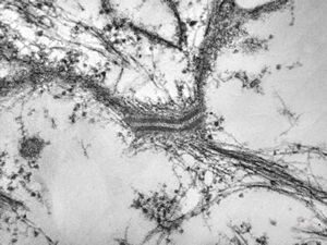 M,8y. | craniopharyngeoma M,8y. | craniopharyngeoma
